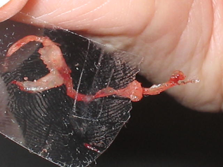 Morgellons nanotech Morgellons nanotech